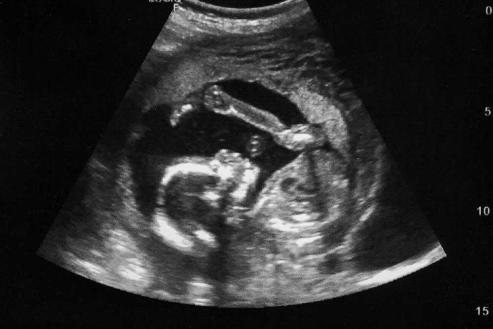 Pregnancy Confirmation Ultrasound